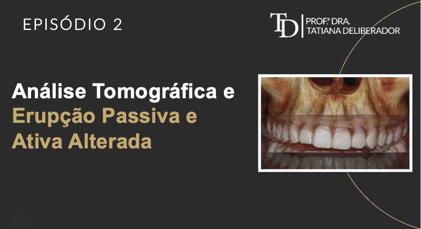 Sorriso Gengival | Análise Tomográfica da Erupção Passiva e Ativa Alterada