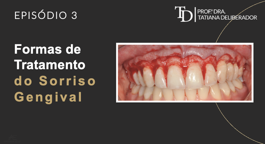 Sorriso Gengival | Formas de Tratamento